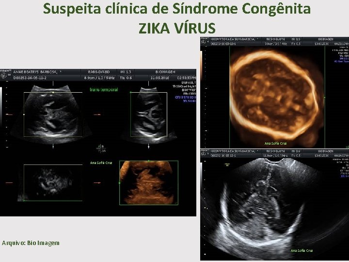 Suspeita clínica de Síndrome Congênita ZIKA VÍRUS Ana Sofia Cruz Arquivo: Bio Imagem Ana