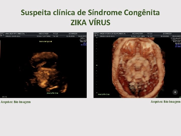 Suspeita clínica de Síndrome Congênita ZIKA VÍRUS Ana Sofia Cruz Arquivo: Bio Imagem 