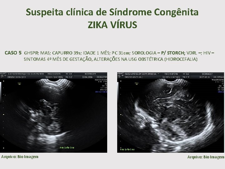 Suspeita clínica de Síndrome Congênita ZIKA VÍRUS CASO 5 GHSPR; MAS; CAPURRO 39 s;