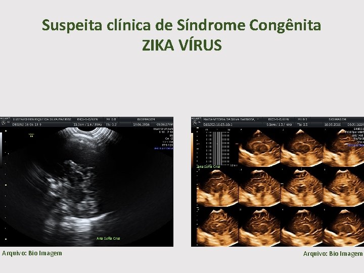Suspeita clínica de Síndrome Congênita ZIKA VÍRUS Ana Sofia Cruz Arquivo: Bio Imagem 