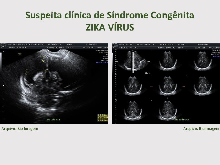 Suspeita clínica de Síndrome Congênita ZIKA VÍRUS Ana Sofia Cruz Arquivo: Bio Imagem 