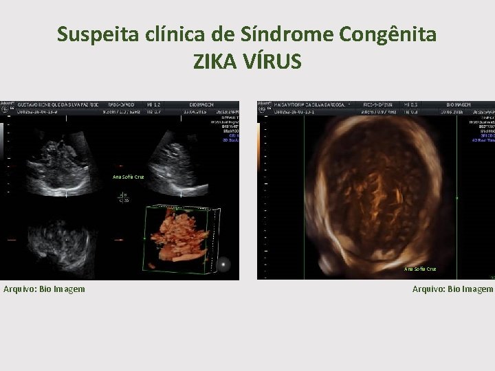 Suspeita clínica de Síndrome Congênita ZIKA VÍRUS Ana Sofia Cruz Arquivo: Bio Imagem 
