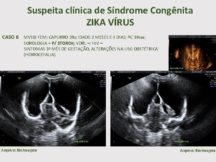 Suspeita clínica de Síndrome Congênita ZIKA VÍRUS CASO 6 MVSB; FEM; CAPURRO 39 s;