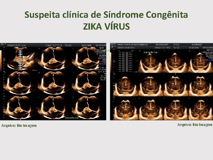 Suspeita clínica de Síndrome Congênita ZIKA VÍRUS Ana Sofia Cruz Arquivo: Bio Imagem 