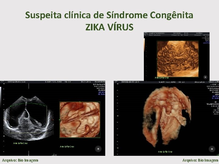Suspeita clínica de Síndrome Congênita ZIKA VÍRUS Ana Sofia Cruz Arquivo: Bio Imagem 