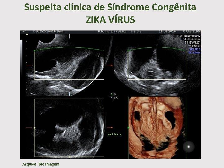 Suspeita clínica de Síndrome Congênita ZIKA VÍRUS Ana Sofia Cruz Arquivo: Bio Imagem 
