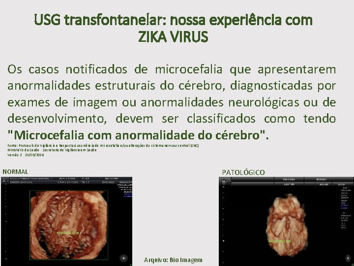 USG transfontanelar: nossa experiência com ZIKA VIRUS Os casos notificados de microcefalia que apresentarem
