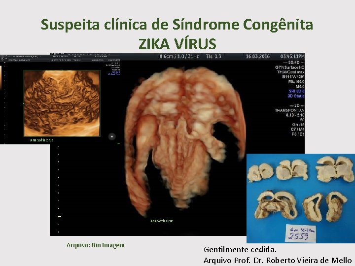 Suspeita clínica de Síndrome Congênita ZIKA VÍRUS Ana Sofia Cruz Arquivo: Bio Imagem Gentilmente