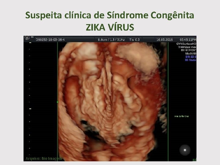 Suspeita clínica de Síndrome Congênita ZIKA VÍRUS Ana Sofia Cruz Arquivo: Bio Imagem 