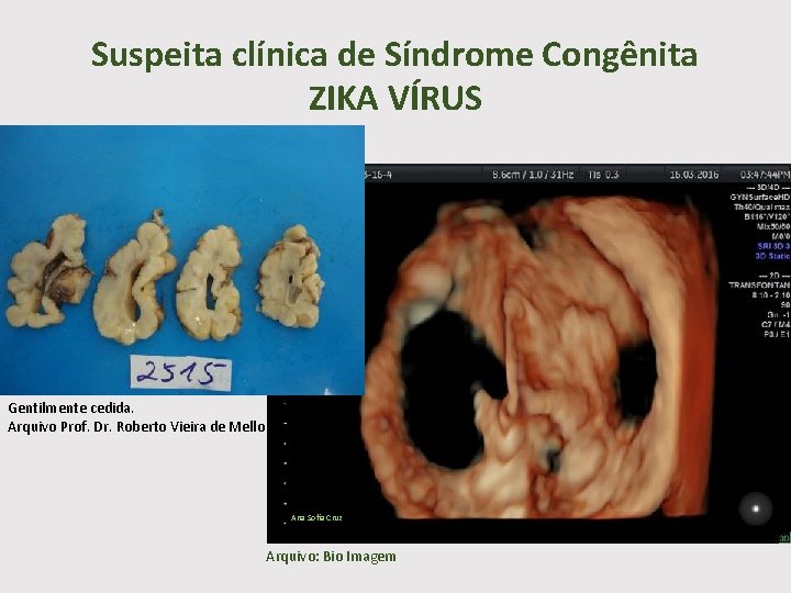 Suspeita clínica de Síndrome Congênita ZIKA VÍRUS Gentilmente cedida. Arquivo Prof. Dr. Roberto Vieira