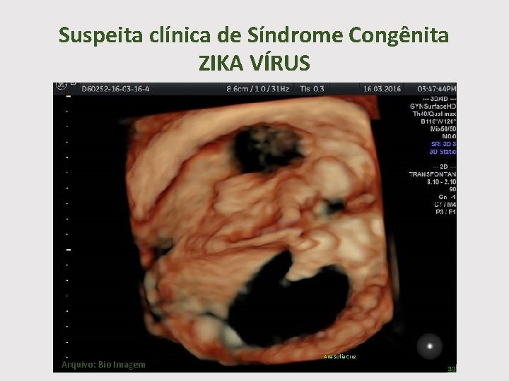 Suspeita clínica de Síndrome Congênita ZIKA VÍRUS Arquivo: Bio Imagem Ana Sofia Cruz 