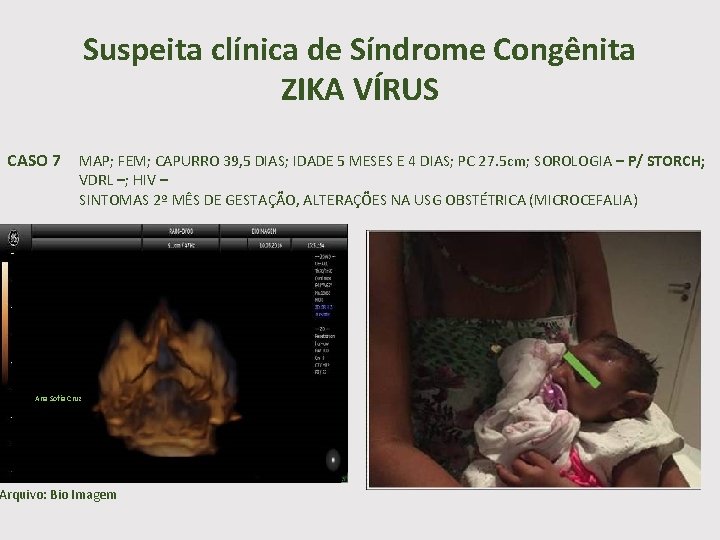 Suspeita clínica de Síndrome Congênita ZIKA VÍRUS CASO 7 MAP; FEM; CAPURRO 39, 5