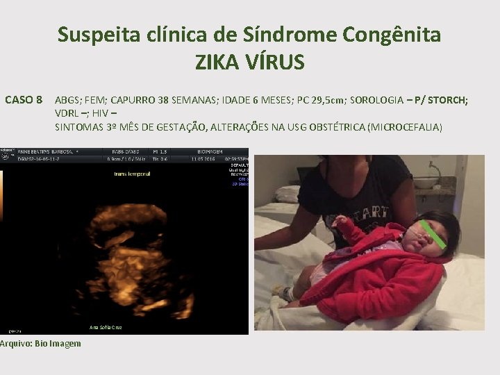Suspeita clínica de Síndrome Congênita ZIKA VÍRUS CASO 8 ABGS; FEM; CAPURRO 38 SEMANAS;