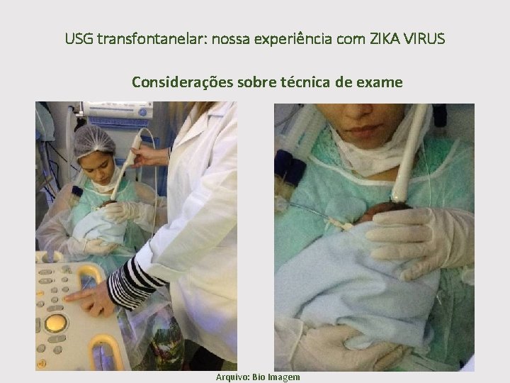 USG transfontanelar: nossa experiência com ZIKA VIRUS Considerações sobre técnica de exame Arquivo: Bio