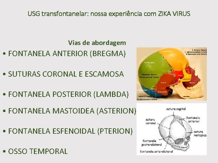 USG transfontanelar: nossa experiência com ZIKA VIRUS Vias de abordagem • FONTANELA ANTERIOR (BREGMA)