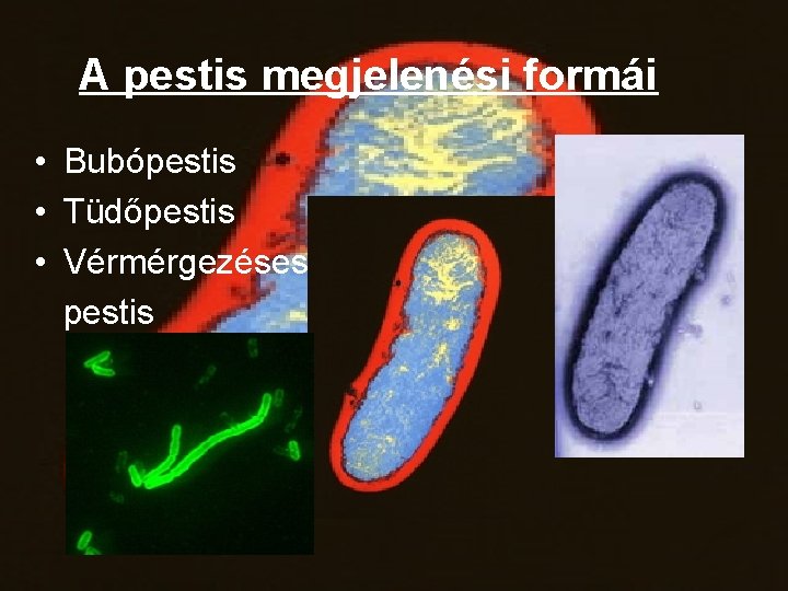 A pestis megjelenési formái • Bubópestis • Tüdőpestis • Vérmérgezéses pestis 