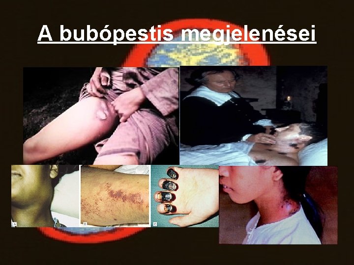 A bubópestis megjelenései 