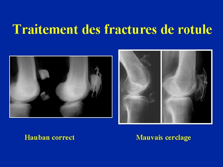 Traitement des fractures de rotule Hauban correct Mauvais cerclage 