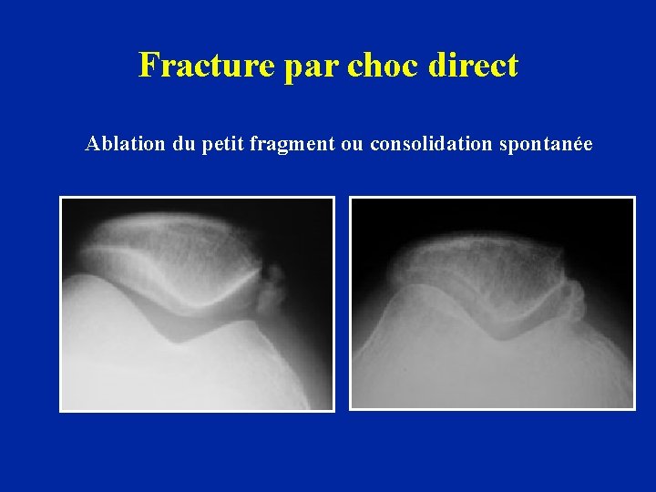 Fracture par choc direct Ablation du petit fragment ou consolidation spontanée 