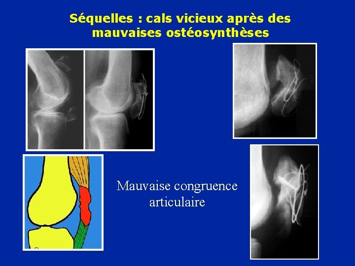 Séquelles : cals vicieux après des mauvaises ostéosynthèses Mauvaise congruence articulaire 