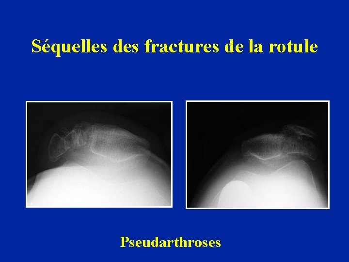 Séquelles des fractures de la rotule Pseudarthroses 