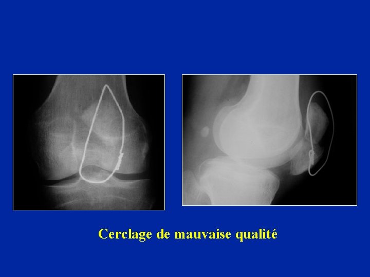 Cerclage de mauvaise qualité 