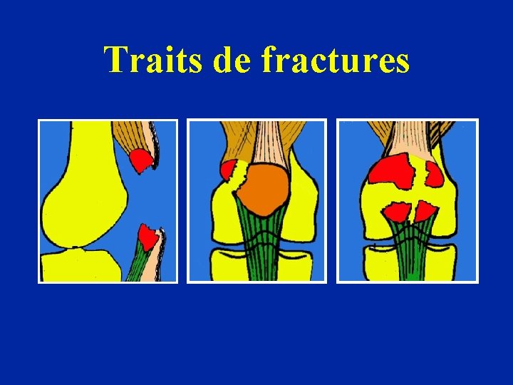 Traits de fractures 