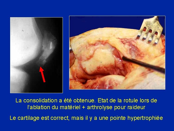 La consolidation a été obtenue. Etat de la rotule lors de l’ablation du matériel