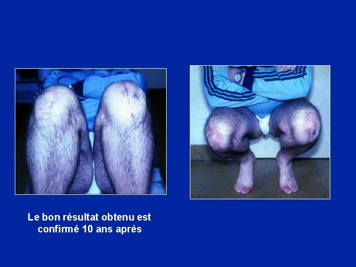 Le bon résultat obtenu est confirmé 10 ans après 