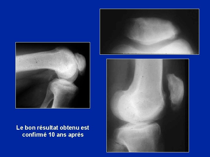 Le bon résultat obtenu est confirmé 10 ans après 