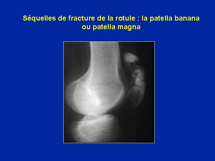 Séquelles de fracture de la rotule : la patella banana ou patella magna 