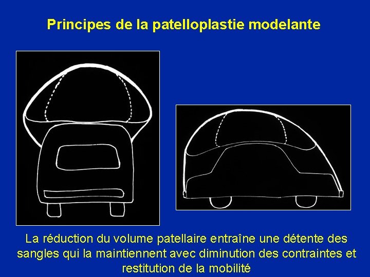 Principes de la patelloplastie modelante La réduction du volume patellaire entraîne une détente des