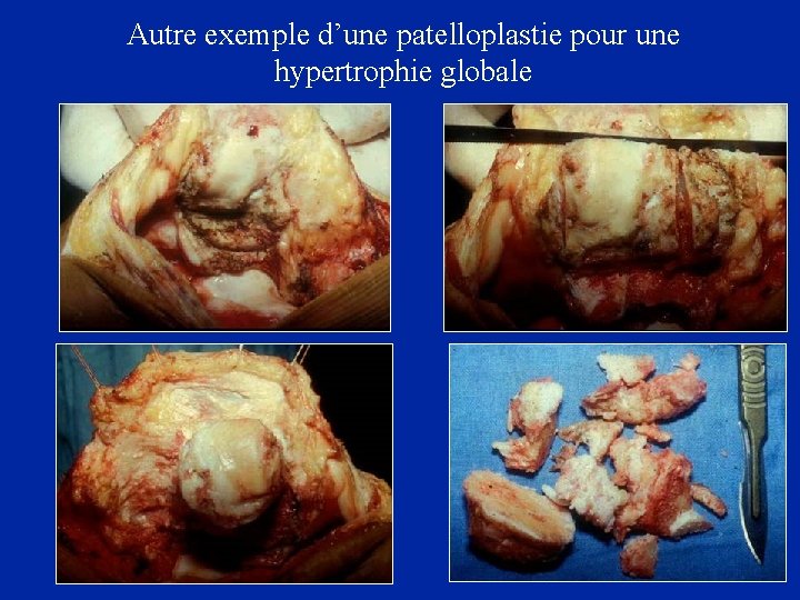 Autre exemple d’une patellaire patelloplastie pour une Technique de réduction en libérant les ailerons