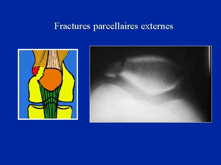 Fractures parcellaires externes 