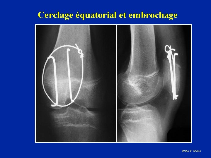 Cerclage équatorial et embrochage Photo F. Chotel 