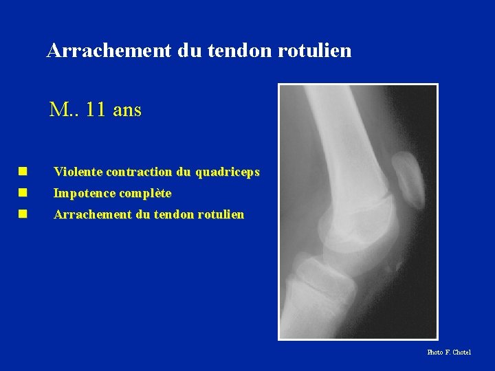 Arrachement du tendon rotulien M. . 11 ans n n Violente contraction du quadriceps