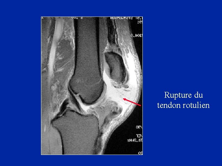 Rupture du tendon rotulien 