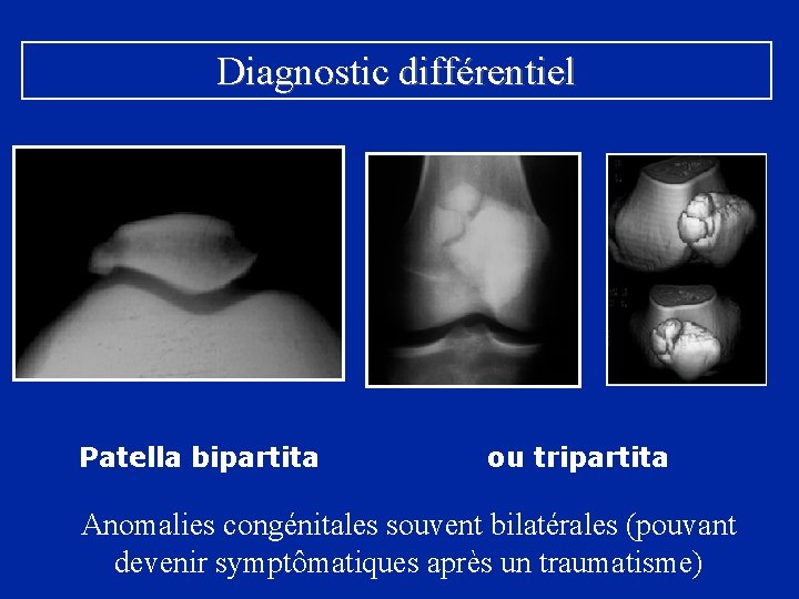 Diagnostic différentiel Patella bipartita ou tripartita Anomalies congénitales souvent bilatérales (pouvant devenir symptômatiques après