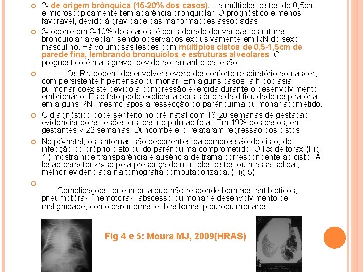  2 - de origem brônquica (15 -20% dos casos). Há múltiplos cistos de