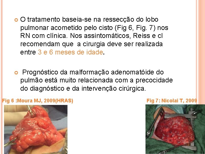  O tratamento baseia-se na ressecção do lobo pulmonar acometido pelo cisto (Fig 6,