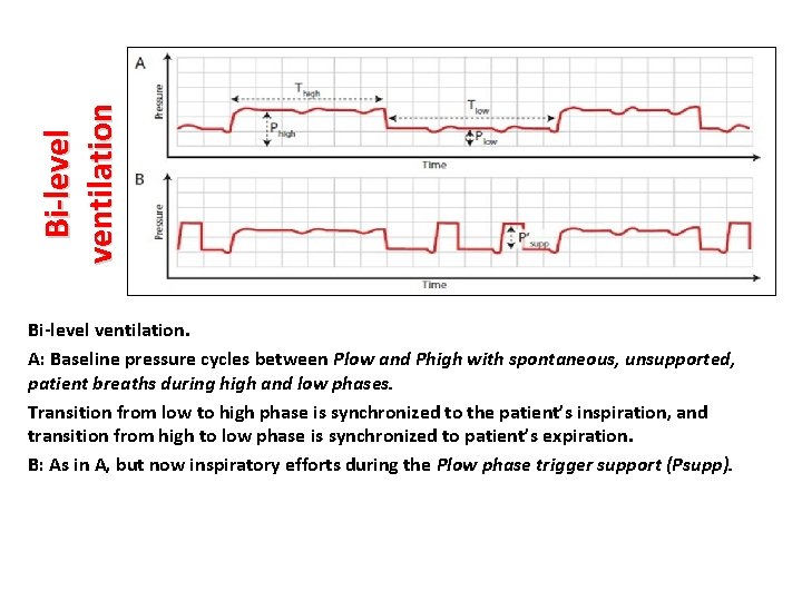 Bi-level ventilation. A: Baseline pressure cycles between Plow and Phigh with spontaneous, unsupported, patient