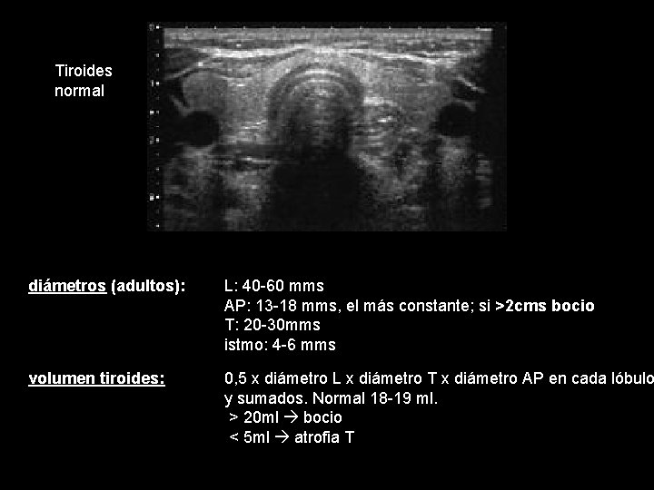 Tiroides normal diámetros (adultos): L: 40 -60 mms AP: 13 -18 mms, el más Tiroides normal diámetros (adultos): L: 40 -60 mms AP: 13 -18 mms, el más