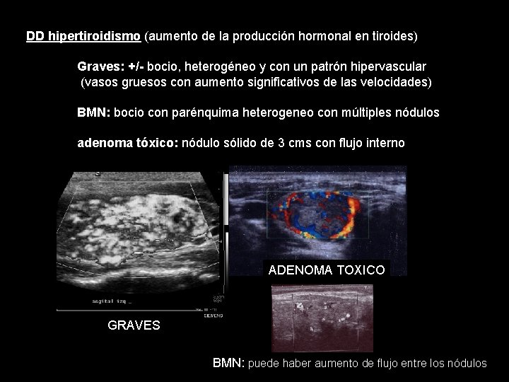 DD hipertiroidismo (aumento de la producción hormonal en tiroides) Graves: +/- bocio, heterogéneo y DD hipertiroidismo (aumento de la producción hormonal en tiroides) Graves: +/- bocio, heterogéneo y
