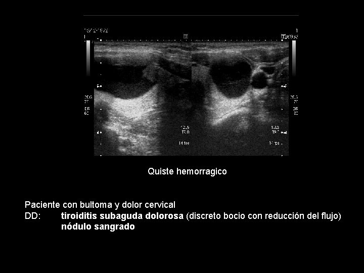 Quiste hemorragico Paciente con bultoma y dolor cervical DD: tiroiditis subaguda dolorosa (discreto bocio Quiste hemorragico Paciente con bultoma y dolor cervical DD: tiroiditis subaguda dolorosa (discreto bocio