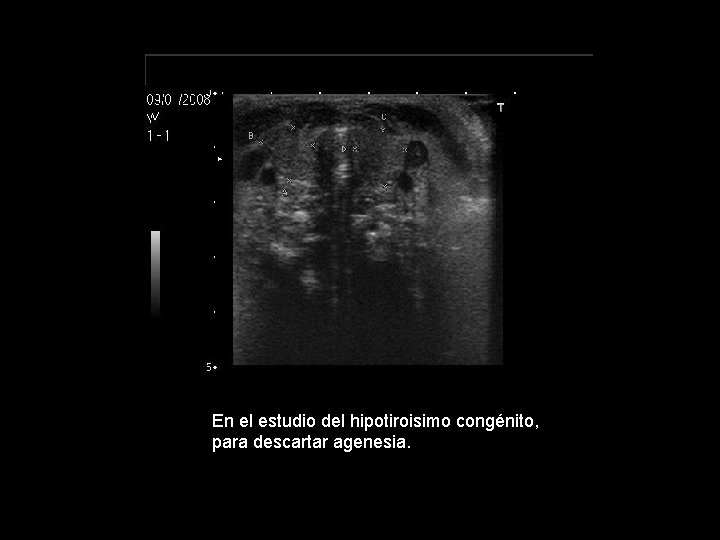 En el estudio del hipotiroisimo congénito, para descartar agenesia. En el estudio del hipotiroisimo congénito, para descartar agenesia.