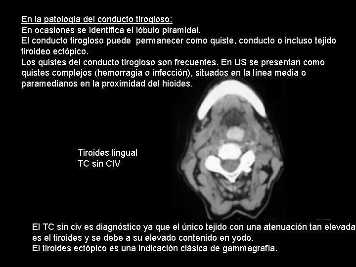 En la patología del conducto tirogloso: En ocasiones se identifica el lóbulo piramidal. El En la patología del conducto tirogloso: En ocasiones se identifica el lóbulo piramidal. El