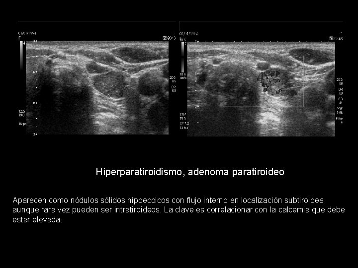 Hiperparatiroidismo, adenoma paratiroideo Aparecen como nódulos sólidos hipoecoicos con flujo interno en localización subtiroidea Hiperparatiroidismo, adenoma paratiroideo Aparecen como nódulos sólidos hipoecoicos con flujo interno en localización subtiroidea