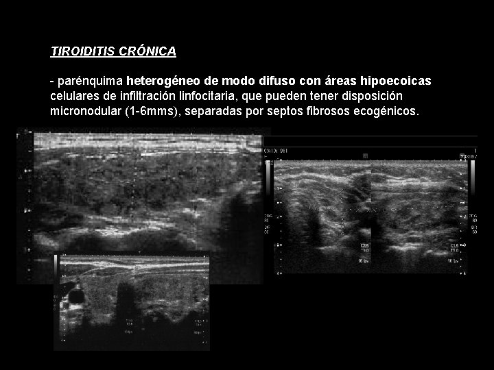 TIROIDITIS CRÓNICA - parénquima heterogéneo de modo difuso con áreas hipoecoicas celulares de infiltración TIROIDITIS CRÓNICA - parénquima heterogéneo de modo difuso con áreas hipoecoicas celulares de infiltración