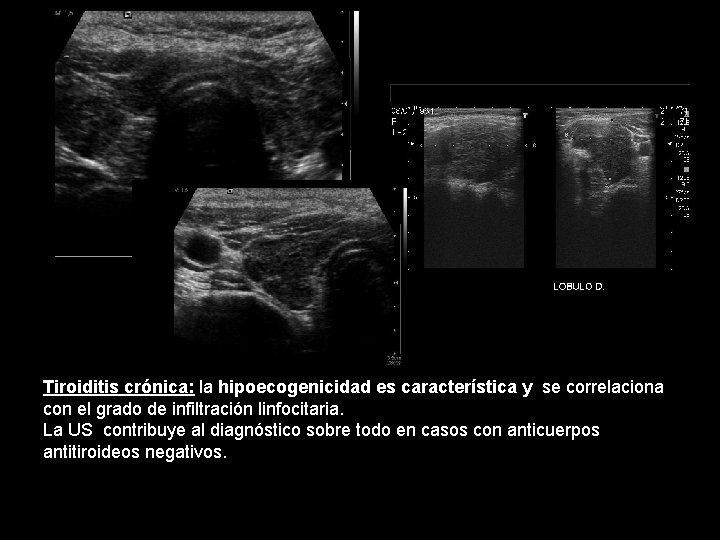 Tiroiditis crónica: la hipoecogenicidad es característica y se correlaciona con el grado de infiltración Tiroiditis crónica: la hipoecogenicidad es característica y se correlaciona con el grado de infiltración
