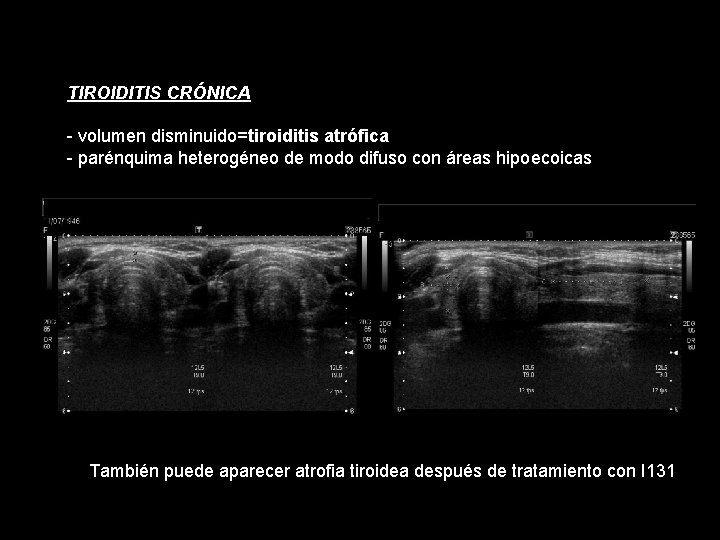 TIROIDITIS CRÓNICA - volumen disminuido=tiroiditis atrófica - parénquima heterogéneo de modo difuso con áreas TIROIDITIS CRÓNICA - volumen disminuido=tiroiditis atrófica - parénquima heterogéneo de modo difuso con áreas